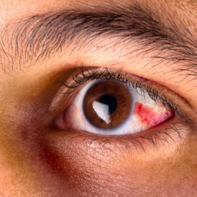 red spot in eye