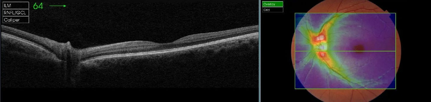 optical coherence tomography