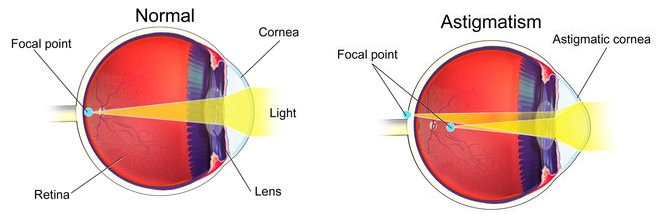 diagram of astigmatism
