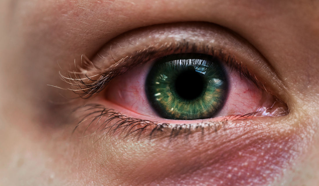 infected eye up close