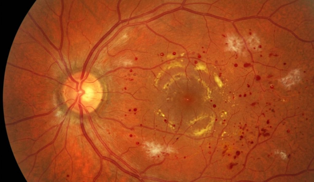 inside look at diabetic retinopathy