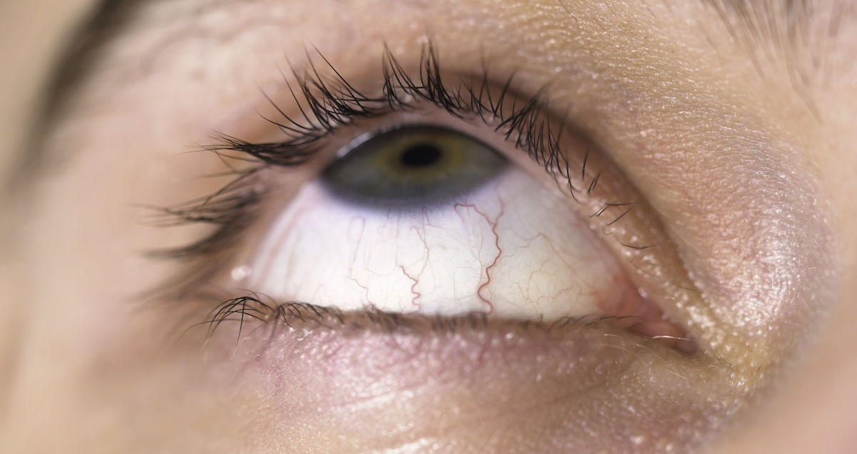 close up of eye irritation
